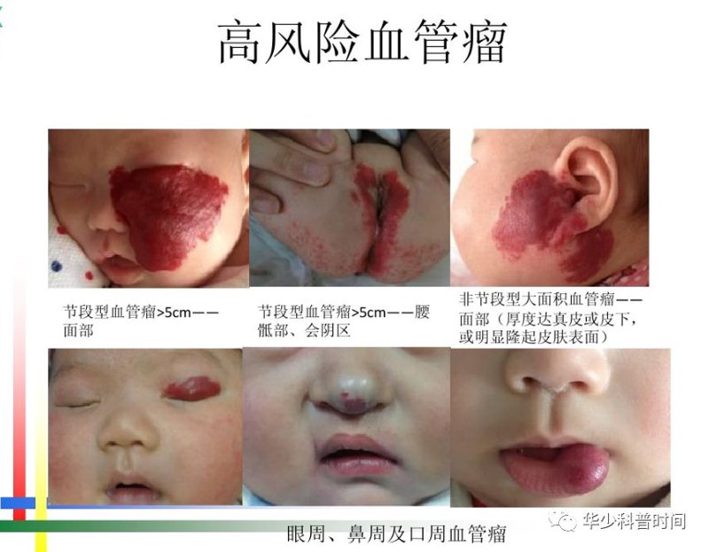 儿童血管瘤治疗